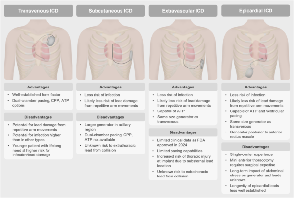 Comparison of implantable cardioverter-defibrillator (ICD) types—transvenous, subcutaneous, extravascular, and epicardial—highlighting differences in placement, advantages, and limitations