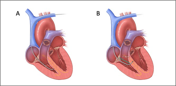 New Global Consensus Establishes Blueprint for Holistic Cardiovascular Implantable Electronic Device Lead Management and Lifelong Patient Safety